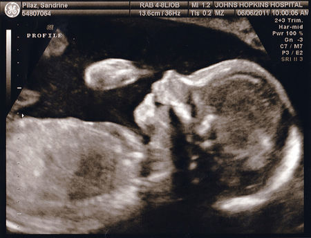 une pièce sexe sexe foetus une pièce sexe sexe foetus